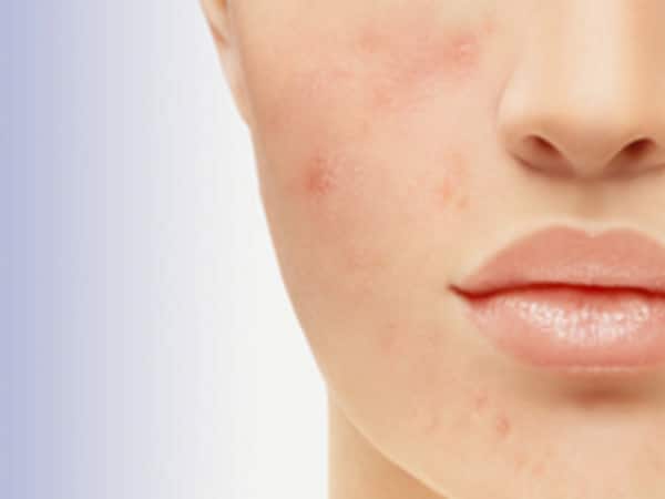 Acne Scar Treatments