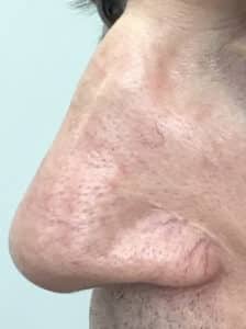 BBL Nasal Vessels