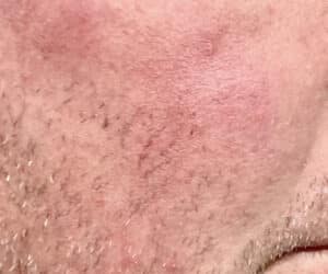 After Image: BBL Rosacea