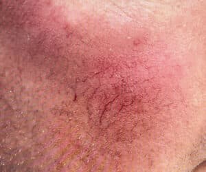 Before Image: BBL Rosacea