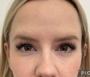 Botox