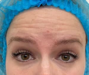 Botox