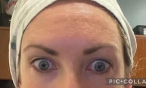 Botox