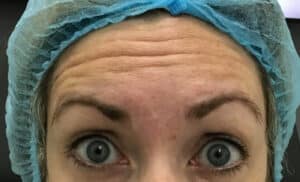 Botox