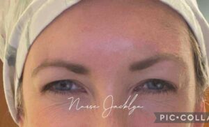 After Image: Botox