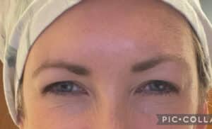 Botox
