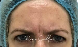 Before Image: Botox