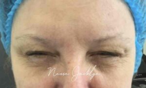 After Image: Botox