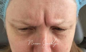 Before Image: Botox