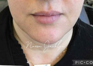 After Image: Botox