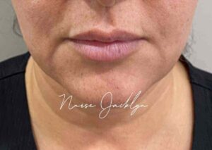 Before Image: Botox