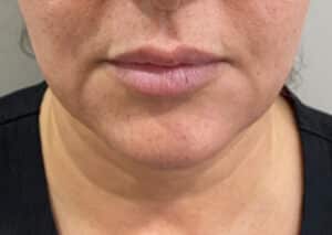 Botox