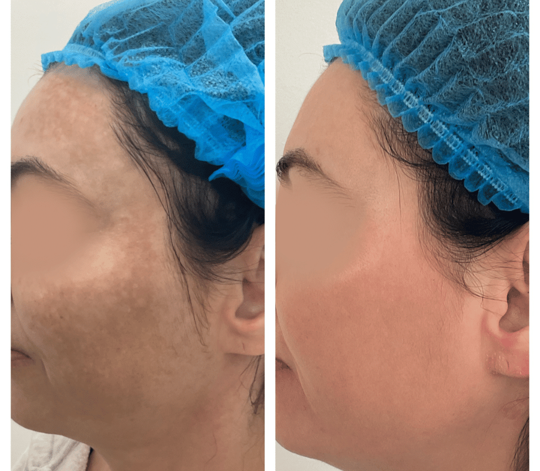 What Is Dermamelan? Distinct Medical Aesthetics