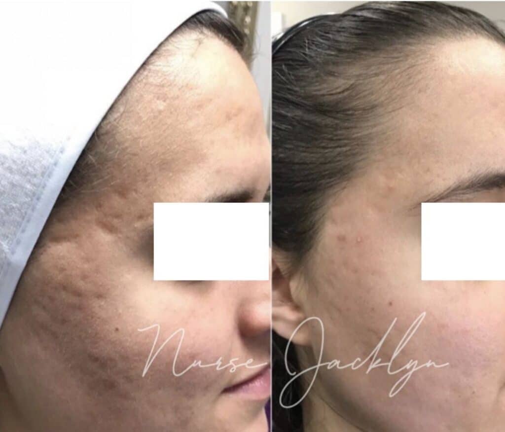 acne scars bellafill result