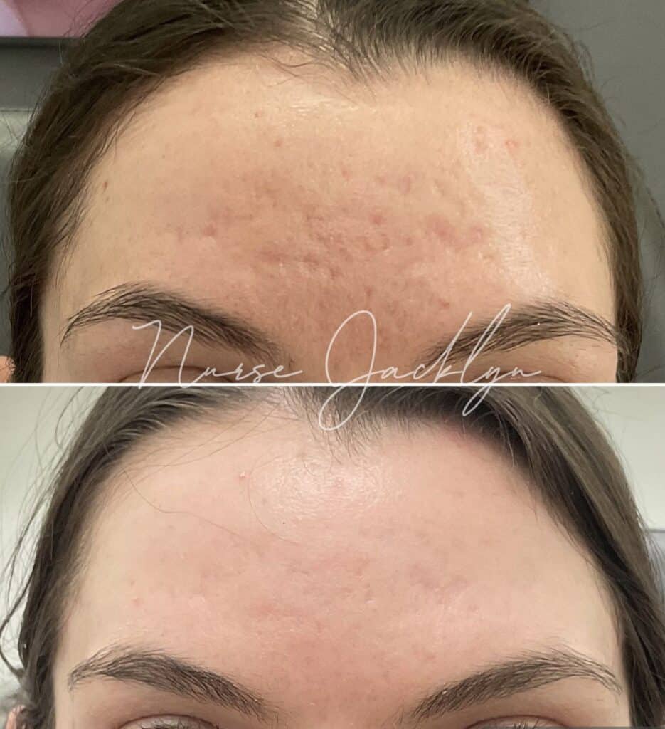 acne scars laser resurfacing result