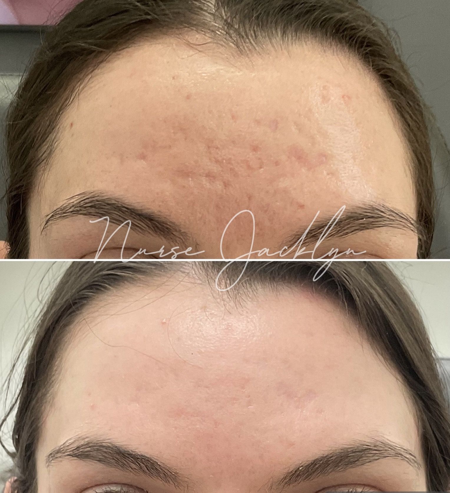 acne scars laser resurfacing