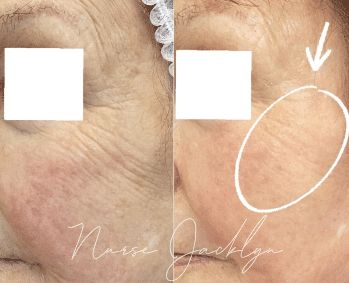 Wrinkle reduction with Sciton Halo by Nurse Jacklyn