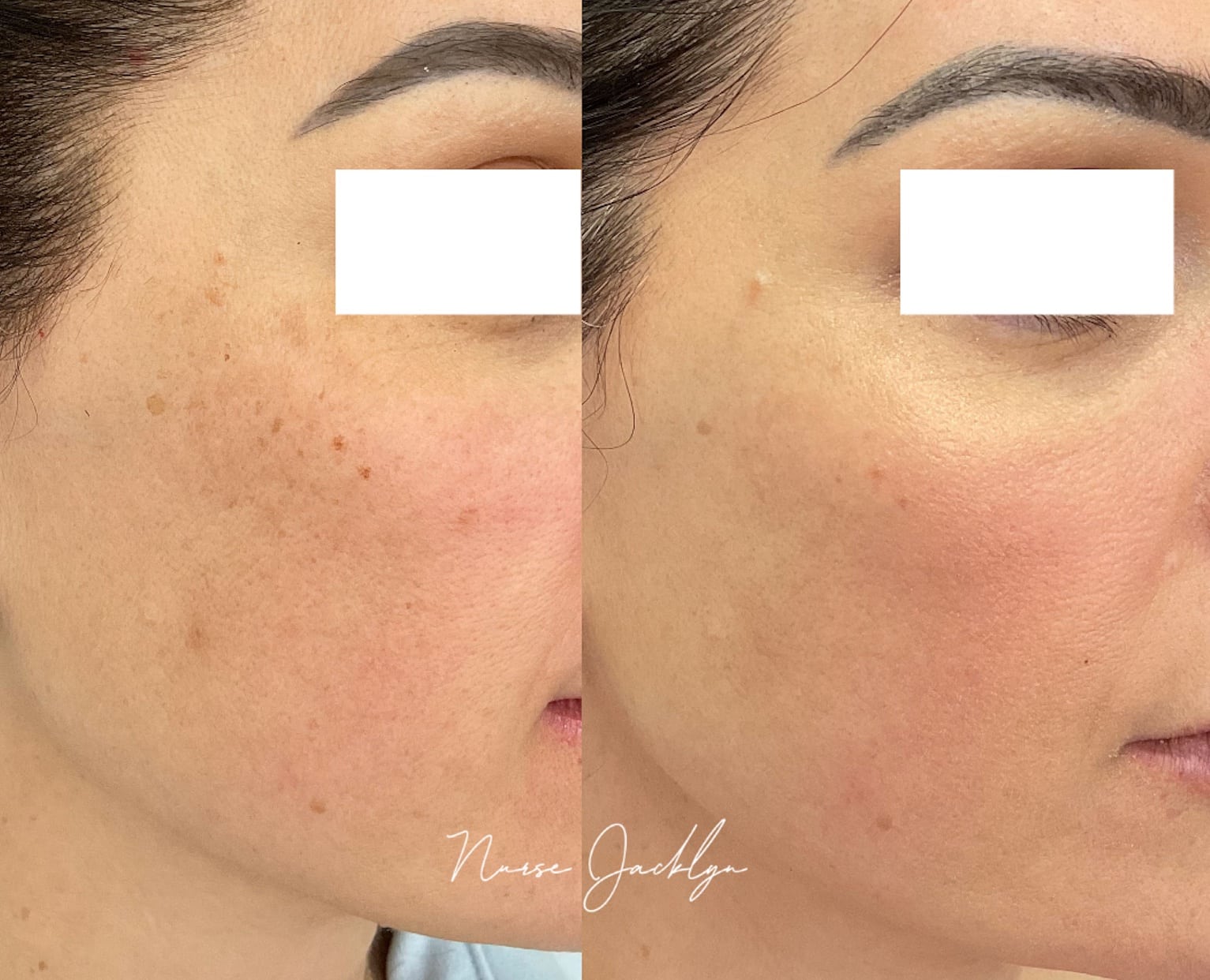 BBL Before After Rosacea by Nurse Jacklyn