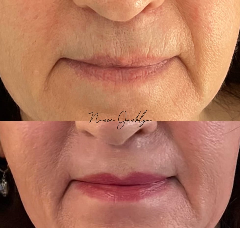 Laser Resurfacing Lips Contour TRL by Nurse Jacklyn