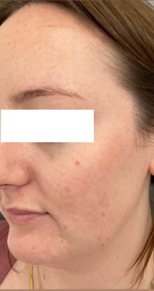 After Image: Chemical Peel - left-front-oblique