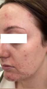 Chemical Peel