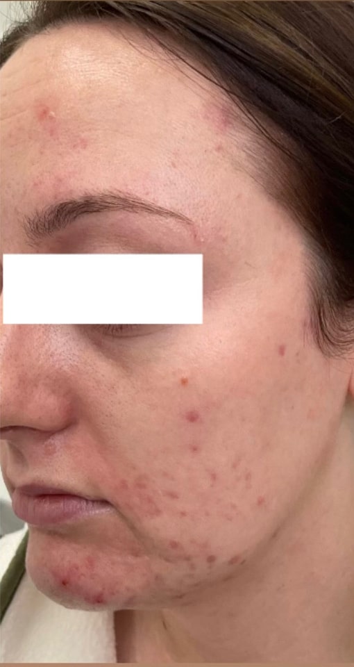 Before Image: Chemical Peel - left-front-oblique