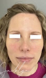 Rosacea with BBL