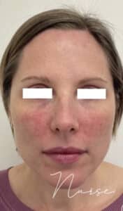 Rosacea with BBL