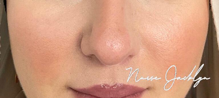 After Image: Rosacea with BBL - front
