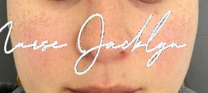 Before Image: Rosacea with BBL
