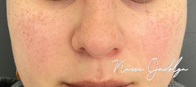 Before Image: Rosacea with BBL - front