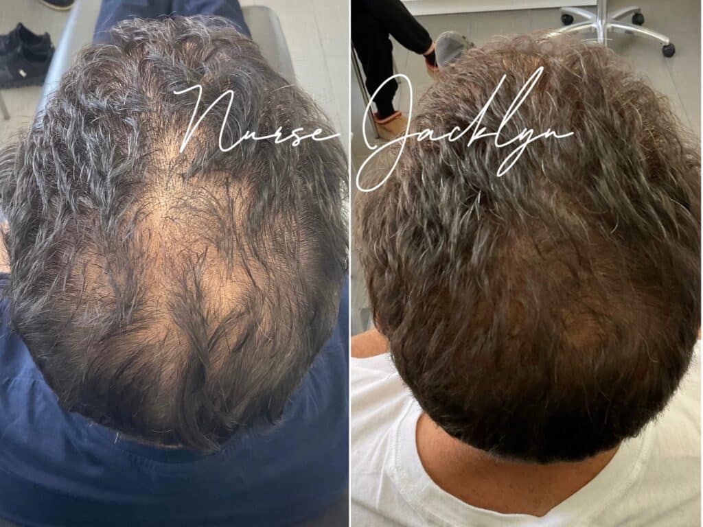 Hair Rejuvenation results showing a reduction in hair loss using Exosomes in a combination treatment