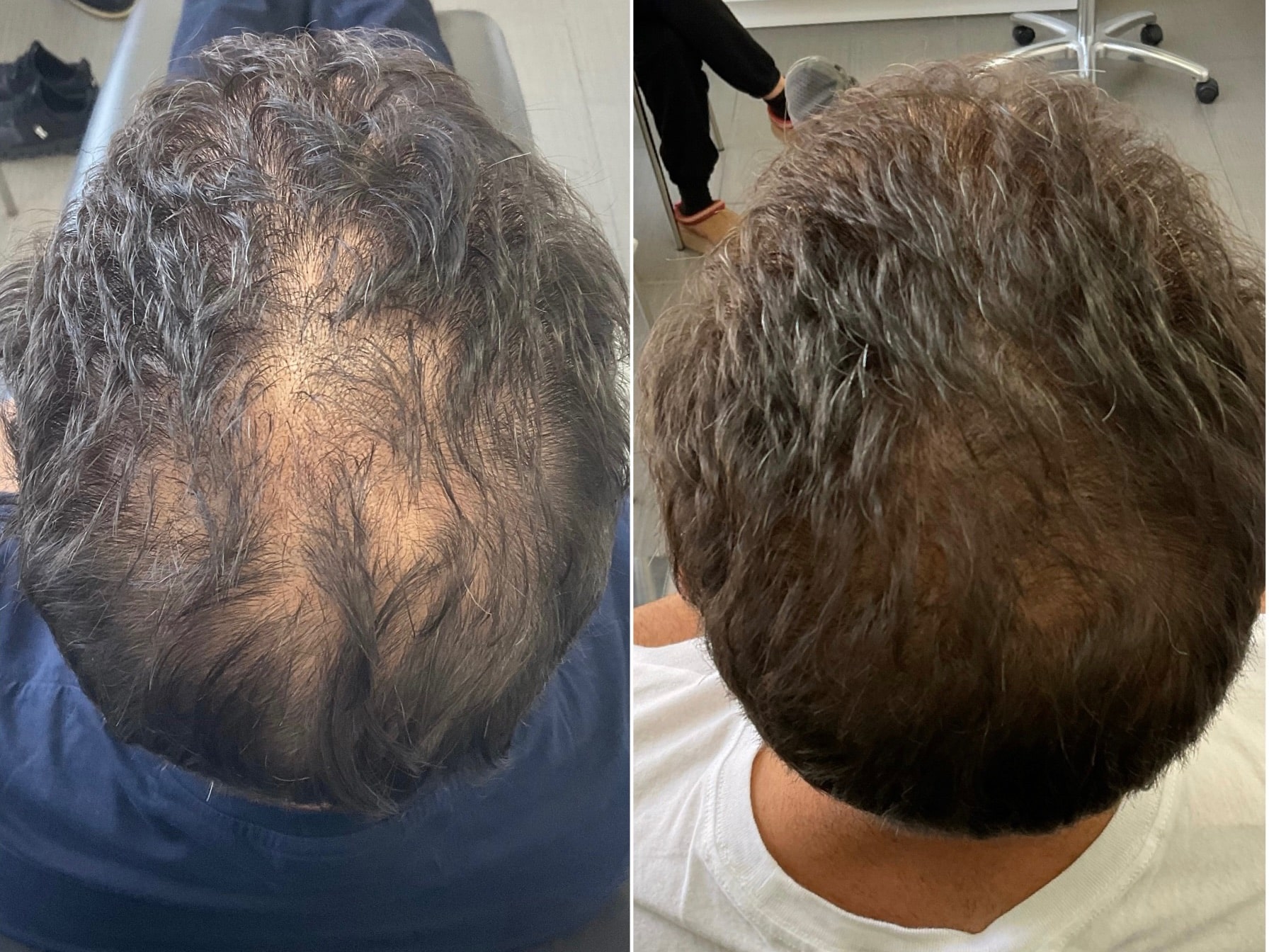 male hair restoration before and after with PRP PRF in Oakville by Nurse Jacklyn