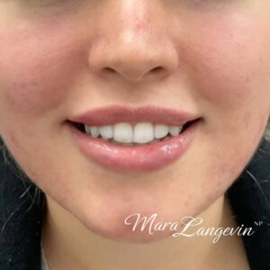 After Image: Botox + Dermal Filler