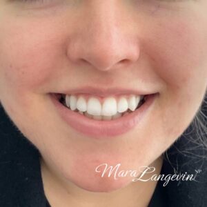 Before Image: Botox + Dermal Filler