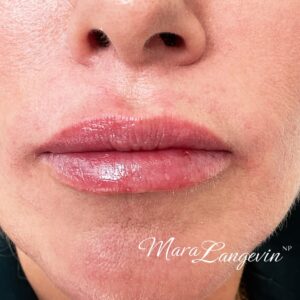 After Image: Dermal Filler