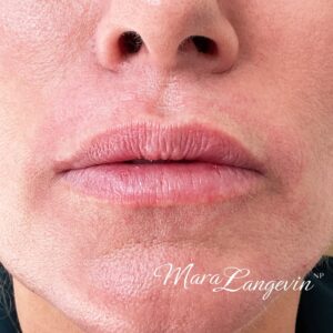 Before Image: Dermal Filler
