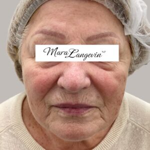 Before Image: Dermal Filler