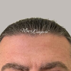 After Image: Botox