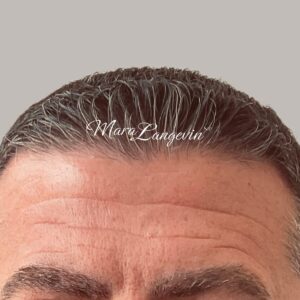 Before Image: Botox