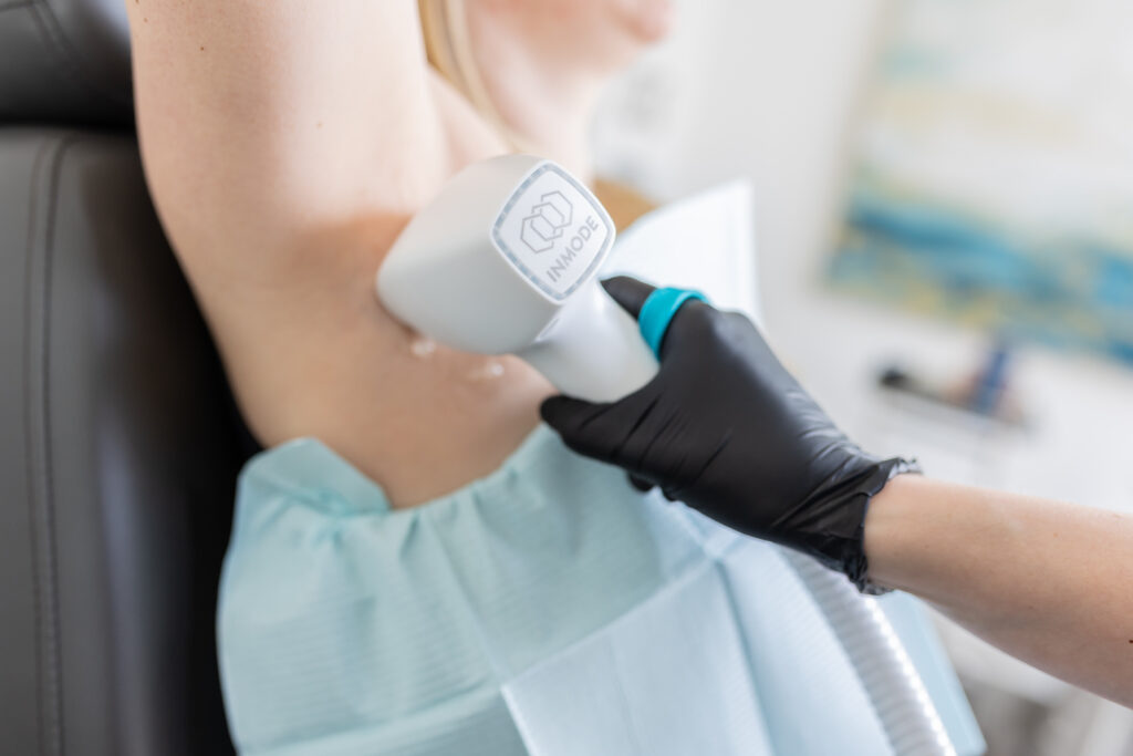 Underarm Laser Hair Removal with Inmode Diolaze XL at Distinct Medical Aesthetics in Oakville