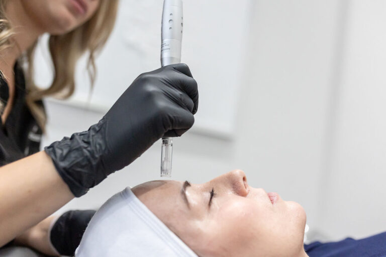Microneedling treatment with the Salient E-PEN at Distinct Medical Aesthetics in Oakville, ON