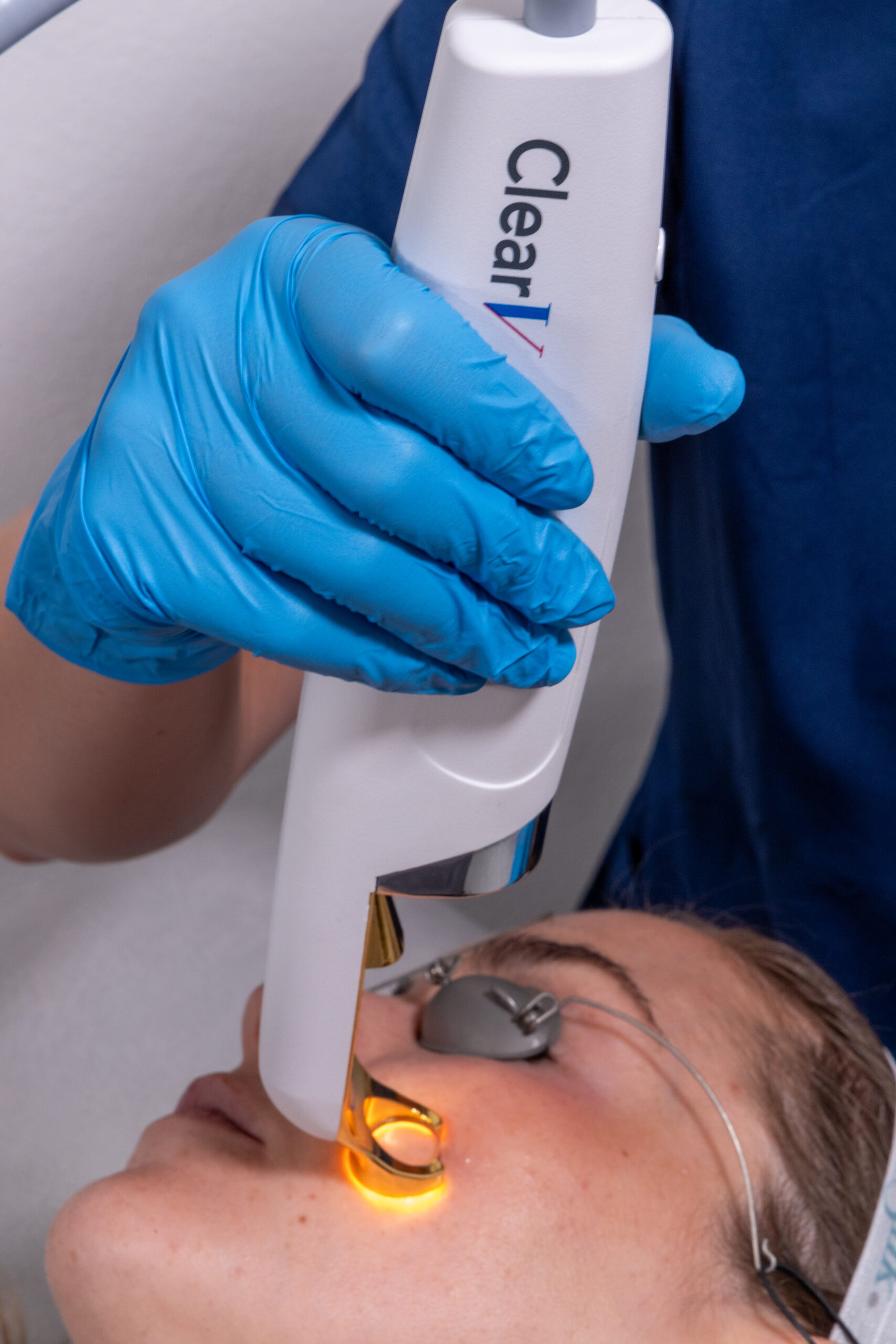 ClearV handpiece treating visible facial vessels on a patient wearing protective eyewear