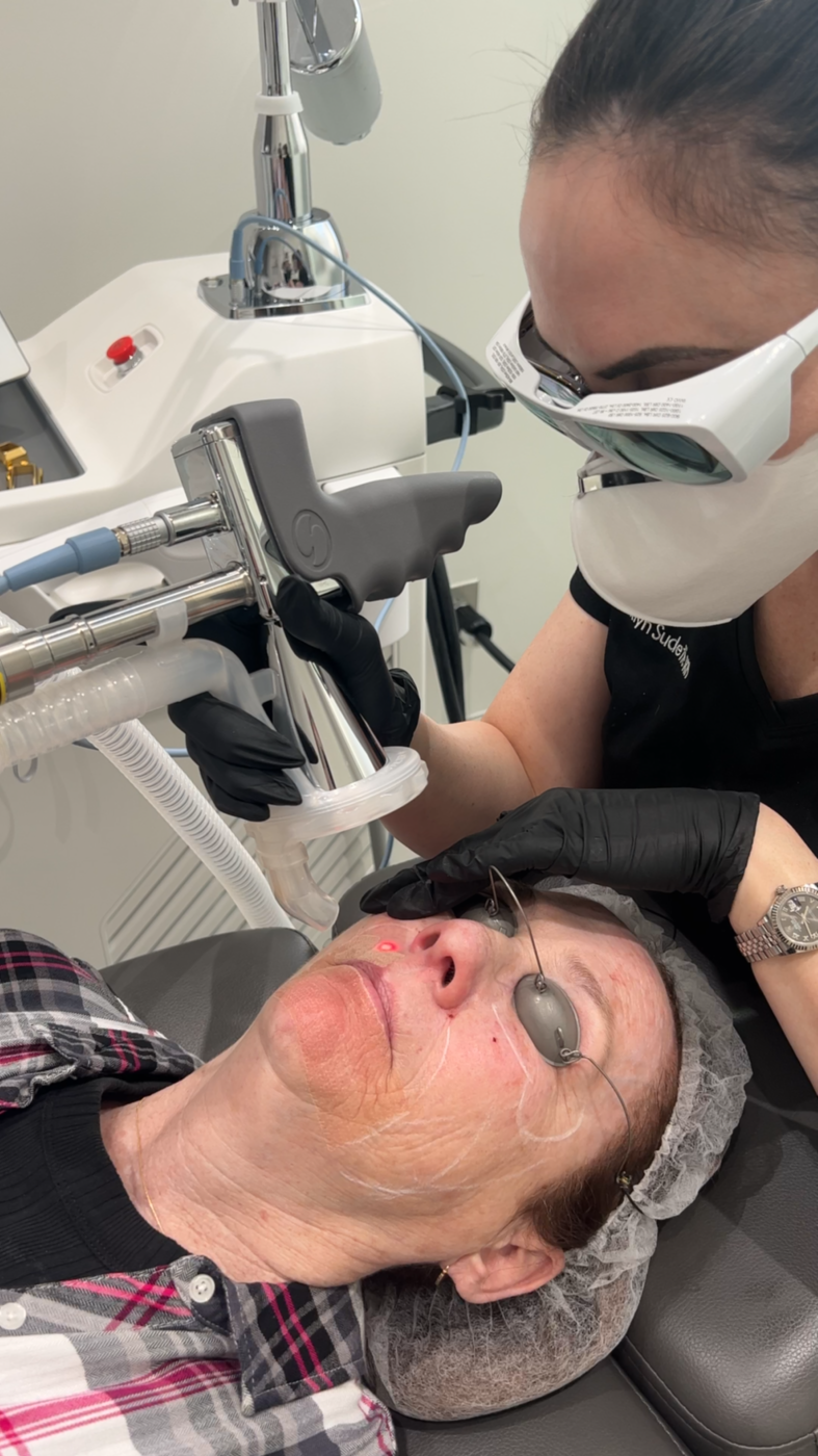 Laser resurfacing treatment in progress for lines around the mouth by Nurse Jacklyn at Distinct Medical Aesthetics