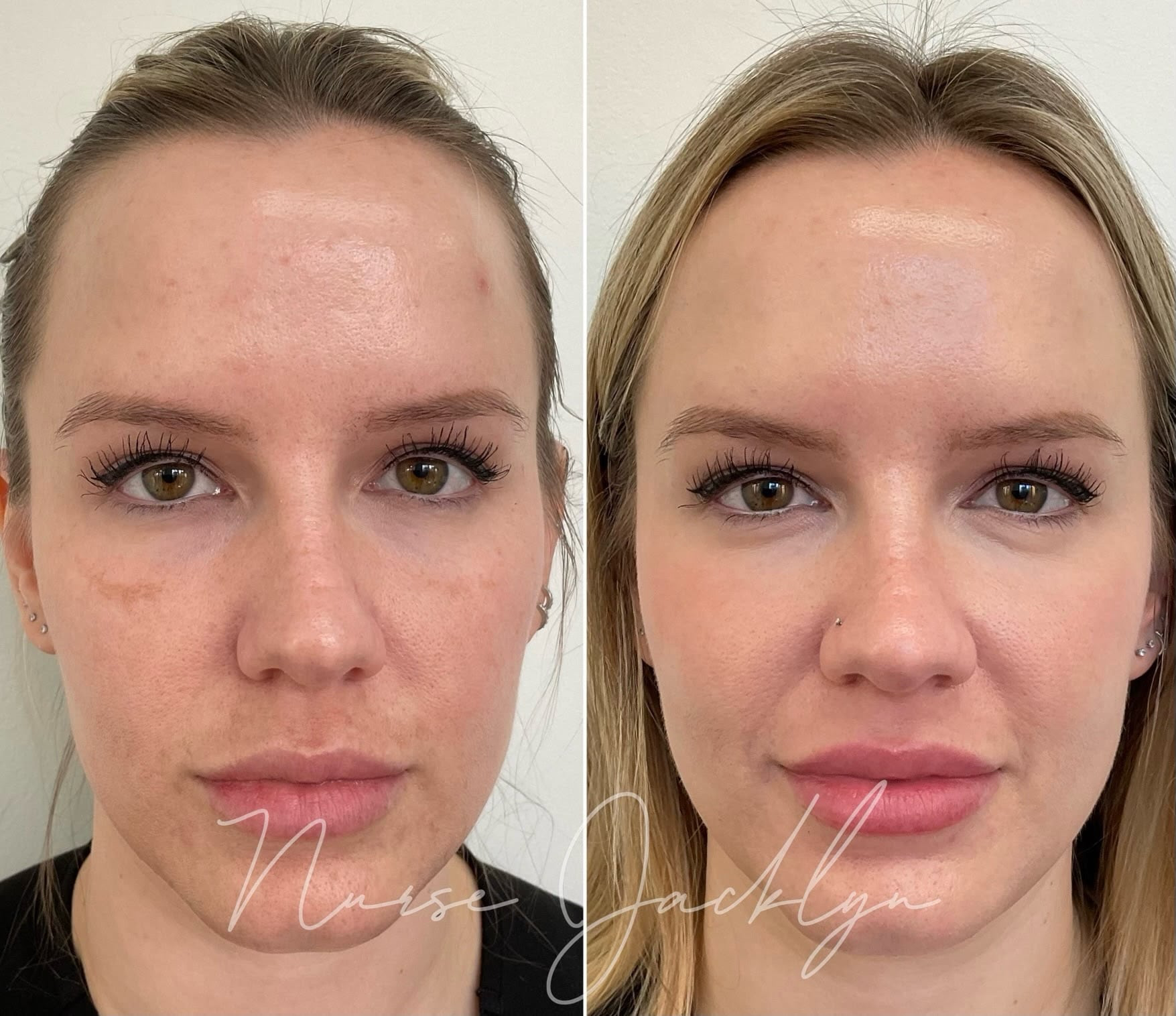 HALO laser performed by Nurse Jacklyn at Distinct Medical Aesthetics before and after showing improvement in facial tone and pigmentation
