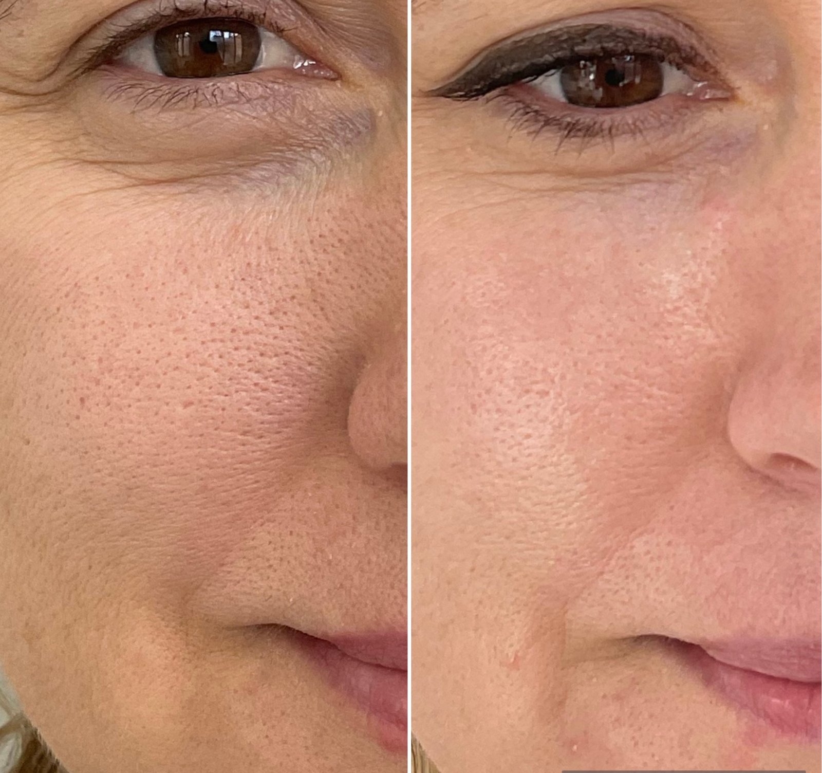 HALO laser performed by Nurse Jacklyn at Distinct Medical Aesthetics before and after showing visible pore and texture refinement