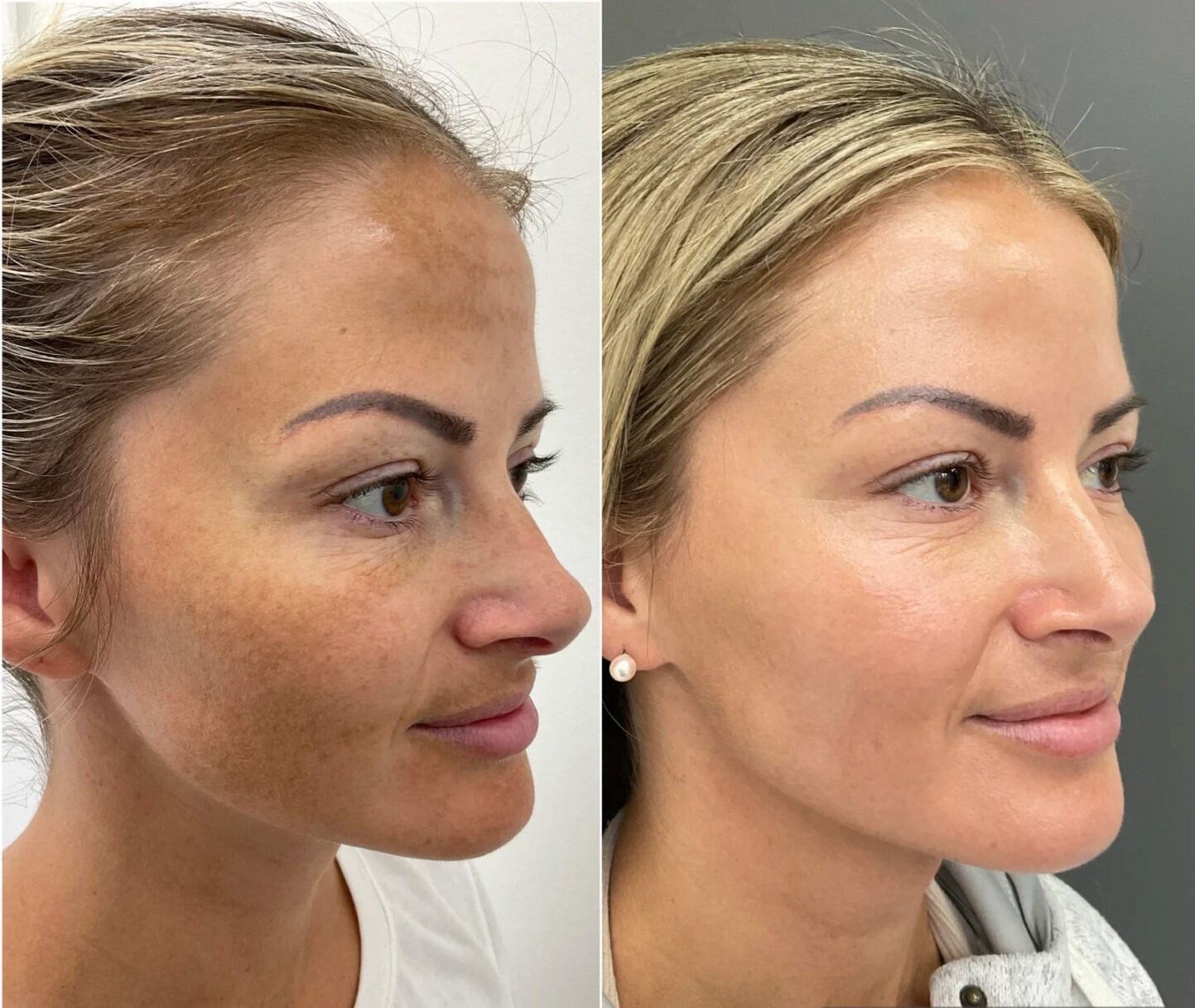 HALO laser performed by Nurse Jacklyn at Distinct Medical Aesthetics before and after for sun damage and skin texture