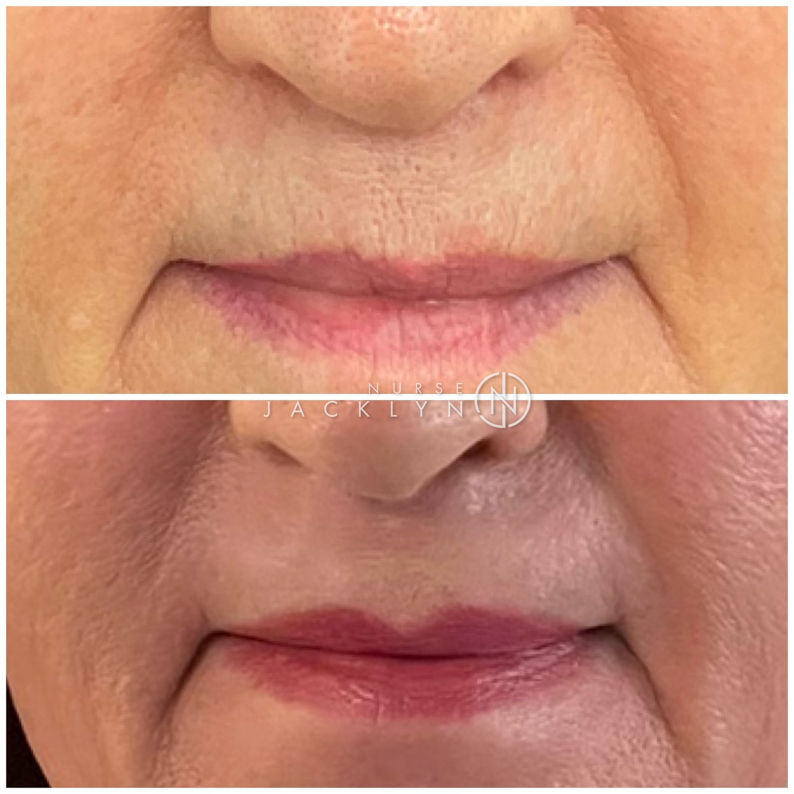 Before and after laser resurfacing results for lines around the mouth by Nurse Jacklyn at Distinct Medical Aesthetics in Oakville
