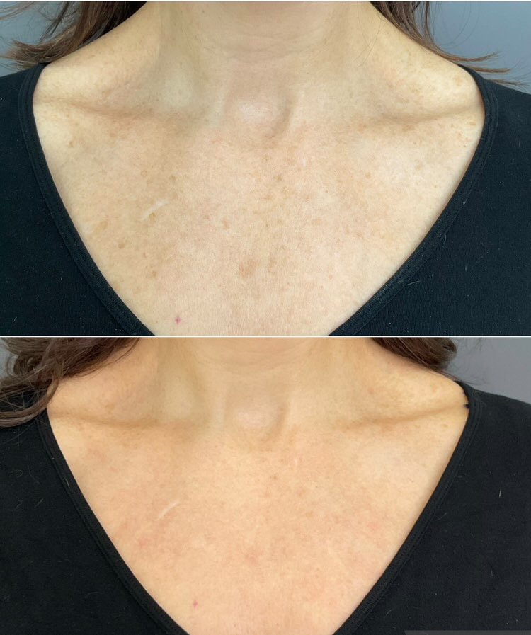 BBL performed by Nurse Jacklyn at Distinct Medical Aesthetics before-and-after photo showing improvement in chest pigmentation