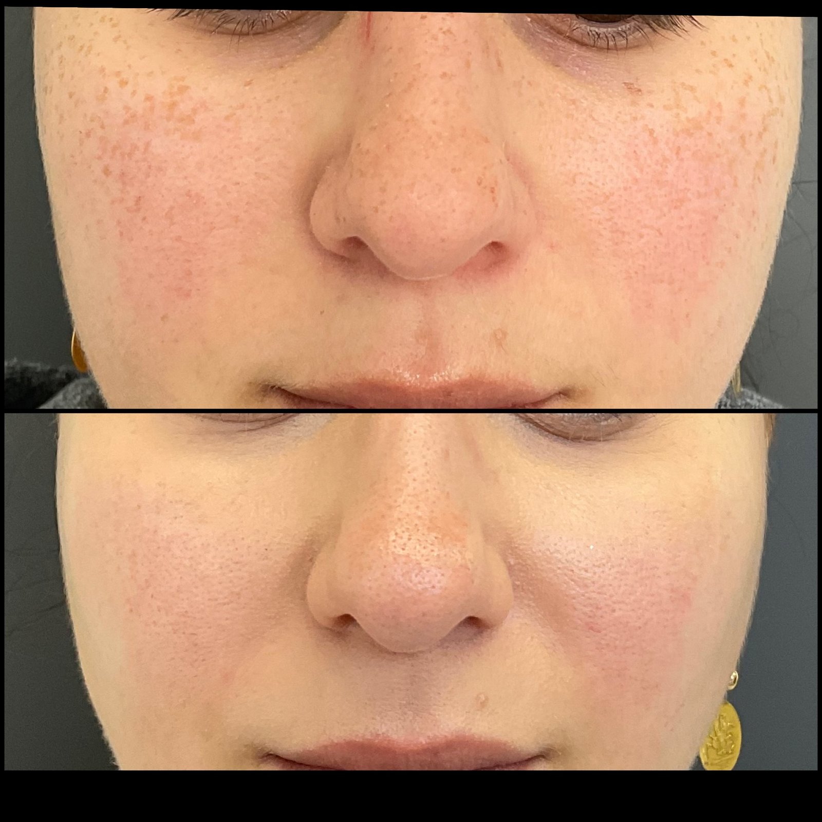 BBL performed by Nurse Jacklyn at Distinct Medical Aesthetics before-and-after photo showing improvement in facial freckles and redness